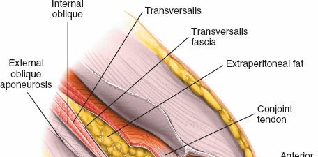 Illustration 18 for Ilioinguinal Approach: Master the Deep Inguinal Ring for Success
