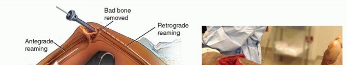 Illustration 10 for Knee Arthrodesis: A Solution for Stable Femur & Tibia Fusion