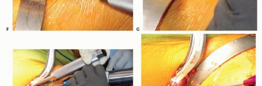 Illustration 32 for Anterior FAI Relief: Mini-Open Anterior Approach Explained