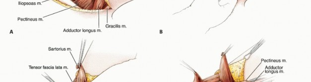 Illustration 11 for Mastering Hip Disarticulation: Through the Hip Joint Capsule