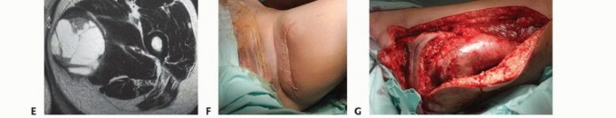 Illustration 39 for Precision Biopsy of Musculoskeletal Tumors for Accurate Diagnosis