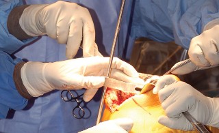 Illustration 21 for Mastering Gap Balancing in Revision TKA: Avoid Common Pitfalls