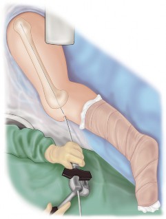 Illustration 15 for Arthrodesis with an Intramedullary Nail: Fixing Failed TKAs