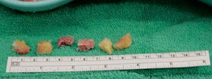 Illustration 19 for Expert Bone Grafting for Primary Total Hip Replacement Success