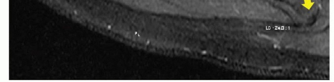 Illustration 11 for Is Your Dorsal Scapular Nerve Causing Snapping Scapula Pain?