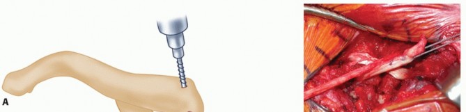 Illustration 24 for Optimizing SC Dislocation Repair After Medial Clavicle Resection