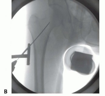 Illustration 26 for Is a Sliding Hip Screw Best for Your Femoral Neck Fracture?