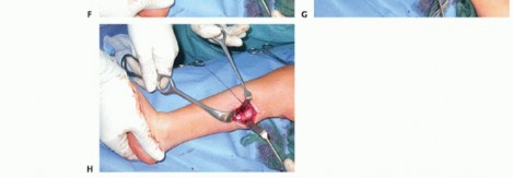 Illustration 42 for How Achilles Tendon Lengthening Fixes Equinocavovarus Foot