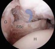 Illustration 7 for Arthroscopic Subscapularis Repair: The lo iky brady Method for Stability