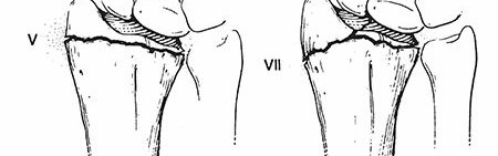 Distal Radius Fractures: What Are They & How Are They Treated?