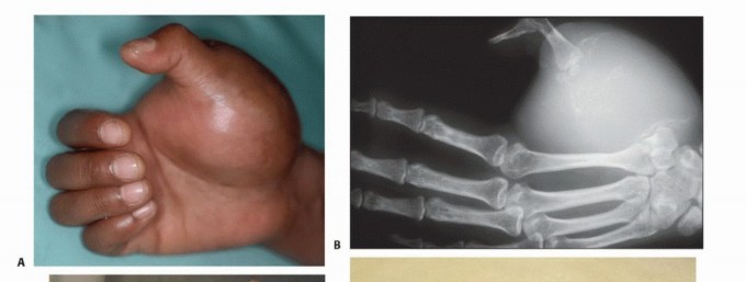 Illustration 5 for Above-Elbow & Below-Elbow Amputations: When & Why They're Needed