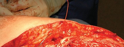 Illustration 100 for Femoral Stem Revision: Posterior Approach for Better Outcomes