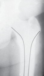 Illustration 13 for Cementless Femoral Stems: Master Indications & Avoid Pitfalls