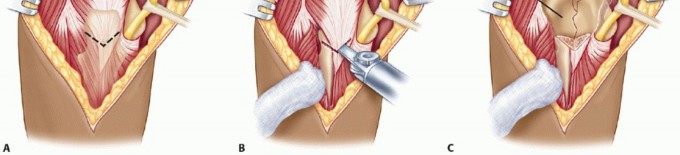 Illustration 48 for Surgical Approaches to Shoulder & Elbow: Pearls and Pitfalls
