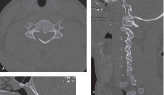 Illustration 20 for Spine Cases: Consider the Patient for Accurate Diagnosis