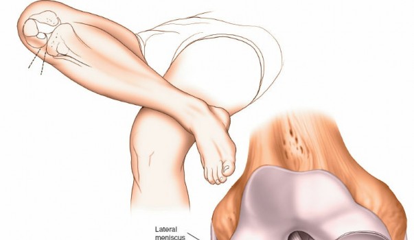 Illustration 25 for Mastering Knee Approaches: Spotlight on Superficial Medial Ligament