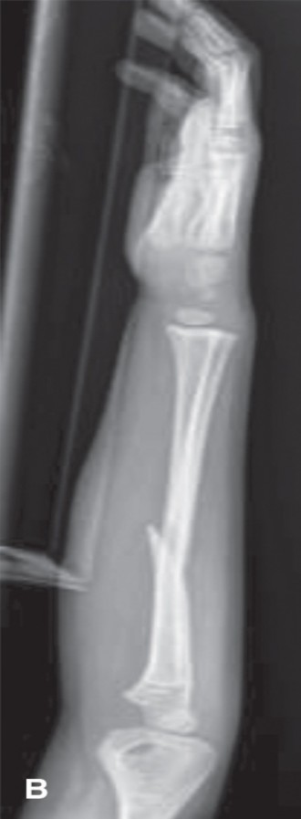 Illustration 2 for 5 Pediatric Fracture Cases: Mastering Reduction and Casting