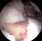 Illustration 31 for Resolving Femoral Head Neck Impingement: Arthroscopic FAI Solutions