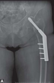 Illustration 9 for THA for patients with proximal femoral deformity: Practical solutions
