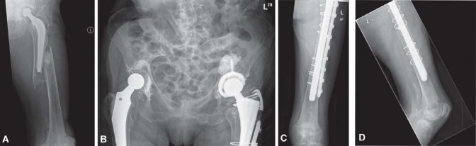 Illustration 26 for Mastering Fractures After Total Hip Arthroplasty