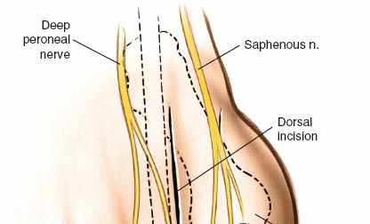 Illustration 193 for Optimized Approaches to the Dorsum of the Foot & Ankle