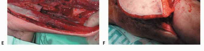 Illustration 30 for Free Vascularized Fibular Grafts: Solving Complex Bone Defects