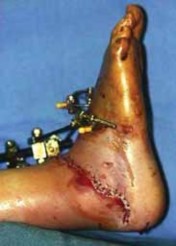 Illustration 40 for Talar Neck Fracture Treatment: Optimizing Recovery with ORIF