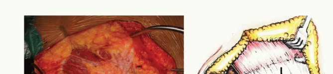 Illustration 26 for Sacral Tumor Surgery: Safeguarding Bowel & Bladder Control