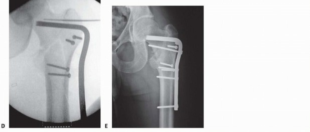 Illustration 18 for ORIF for Peritrochanteric Hip Fractures: Achieve Stable Mobility