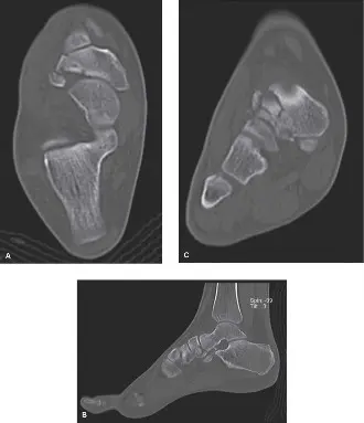 صورة توضيحية لـ كسور العظم الزورقي في القدم الأسباب الأعراض والعلاج مع الأستاذ الدكتور محمد هطيف
