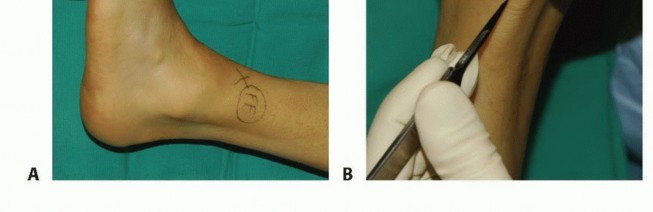 Illustration 2 for Foot Drop Surgery: How a Pin or Drill Elevates Tendon Transfer