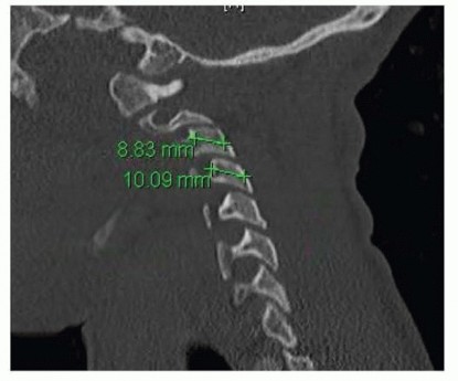 Cervical Fusion: Enhancing Stability with Lateral Mass Screws