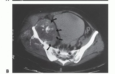 Illustration 13 for Surgical Pelvic Resection: Gluteus Maximus Muscle & Nerve Preservation