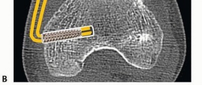 Illustration 14 for Chronic Patellar Instability: From Acute Onset to Lasting Solutions