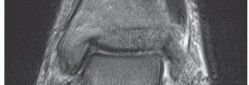 Illustration 9 for Medial Ankle Instability: Find Relief with Reconstruction