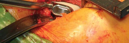 Illustration 45 for Kinectiv® Stem: Modular Necks for Primary THA Success