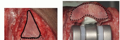 Illustration 38 for Distal Humeral Fractures: When Is Elbow Replacement the Best Option?