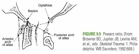 Illustration of occipitoatlantal dislocation craniovertebral - Dr. Mohammed Hutaif