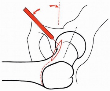 Illustration 20 for Sliding Trochanteric Osteotomy: Modern Role & Refined Techniques