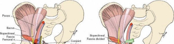 Illustration 80 for Pelvis & Acetabulum Approaches: Unlocking the Posterior Superior Iliac