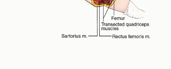 Illustration 19 for Anterior Flap Hemipelvectomy: Leveraging fig tech fig for Difficult Tumors