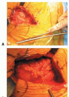 Illustration 42 for Hemiarthroplasty of the Hip: Indications & Types Explained