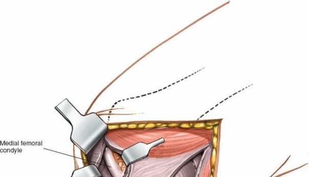 Illustration 76 for Mastering Knee Approaches: Spotlight on Superficial Medial Ligament