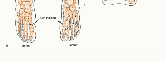 Illustration 24 for Treating Tumors of the Foot: Optimizing Amputation & Resection