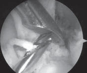 Illustration 13 for Successful Ligament Repair Revision: Fixing Failed ACLs