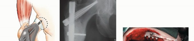 Illustration 20 for Mastering Femoral Metastases: Optimal Function for Femoris & Vastus