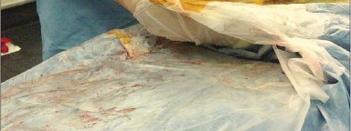 صورة طبية: إتقان توازن الأنسجة الرخوة لمفصل ورك صناعي مثالي: دليل شامل للمرضى مع الأستاذ الدكتور محمد هطيف