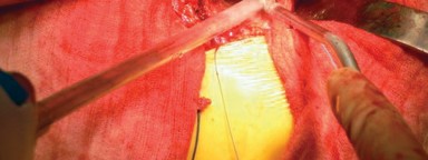 Illustration 19 for Cemented Femoral Stem Figures: Surgical Anatomy & Placement