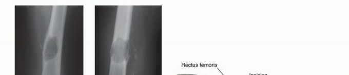 Illustration 24 for Mastering Femoral Metastases: Optimal Function for Femoris & Vastus