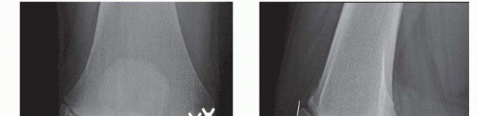 Illustration 10 for Chronic Patellar Instability: From Acute Onset to Lasting Solutions